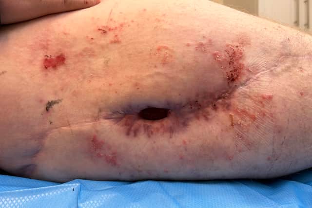 Tom Moss' hole in his leg