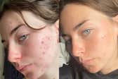 Get clearer skin with 47 Skin no more dryness, flaking or waiting months to see a change