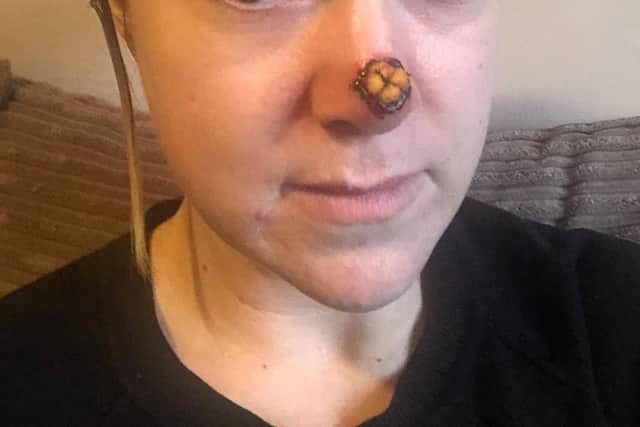 Mandy after her skin graft. Photo: SWNS