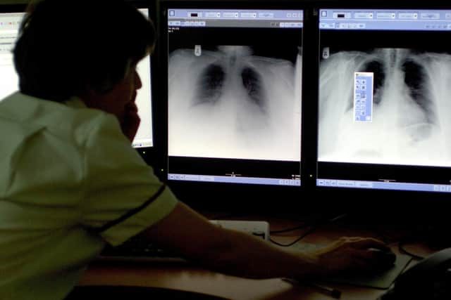 TB rates are high in Peterborough compared to the national average. Photo: PA EMN-200810-125708001