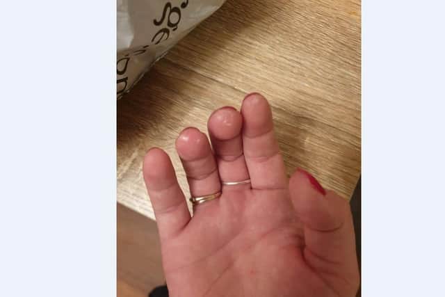 The burns left on Patrice's fingers after opening the package
