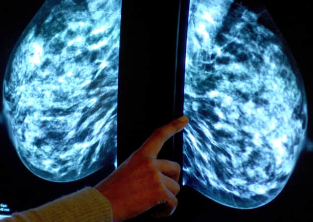 Thousands of women miss “vital” breast cancer screenings in Peterborough. Photo: PA EMN-210110-122116001