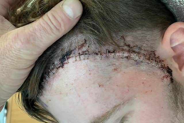 Bradley had 33 staples in his scalp after emergency brain surgery