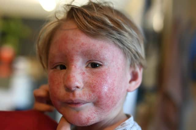 Three-year-old Gabriel has had severe eczema since he was just a month old.