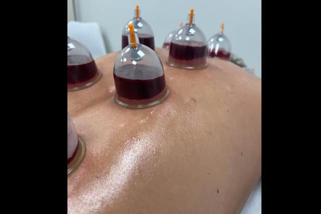 An example of wet cupping.