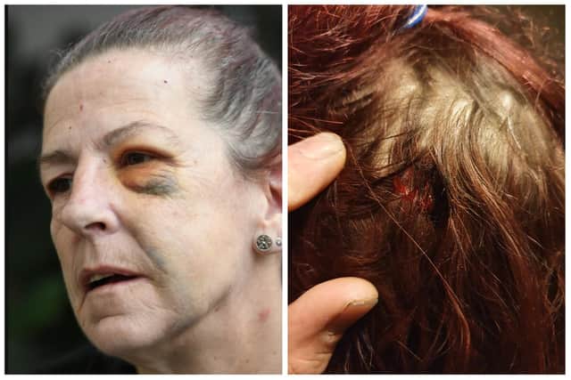 Suzan English pictured left on November 29 alongside an image showing the wound to the back of her head.