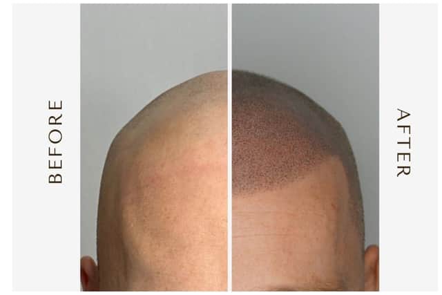 This image shows how hair loss, left, can be hidden using the skills of Peterborough tattoo artist Leigh Tilbrook, right