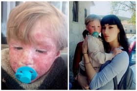 Ines Dias, 22, launched a gofundme campaign to help pay for specialist treatment available overseas for children like her son Gabriel, 3, who has severe eczema.