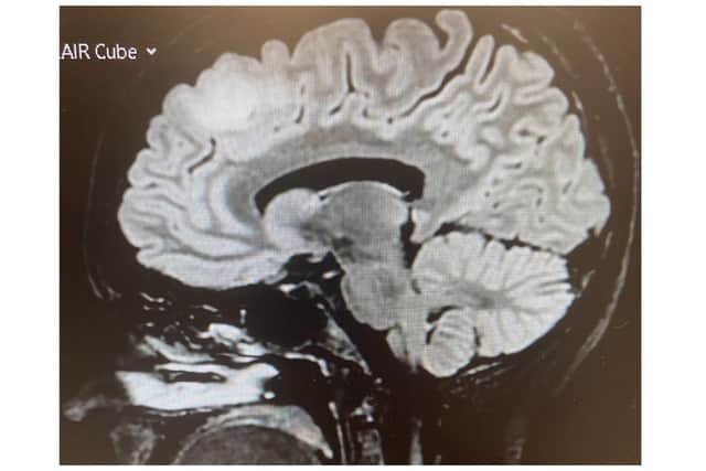 A scan showing the tumour. Image: Brain Tumour Research
