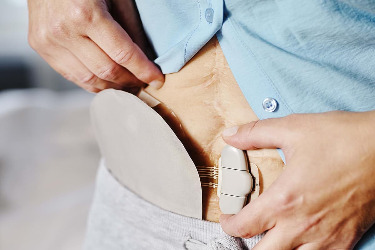 Stoma Device Peterborough's Coloplast unveils new digital device to bring comfort to ...