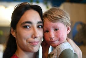 Ines Mendes Dias is hoping her crowdfunding campaign will enable her son Gabriel, 3, to receive specialist skin treatment in Portugal.