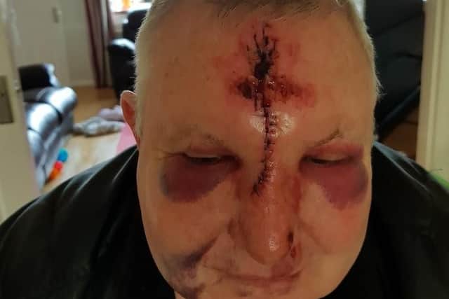 Philip Wetherilt suffered serious facial injuries in the attack
