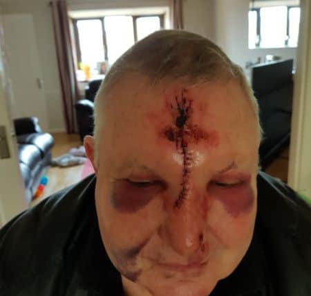 Phil's injuries