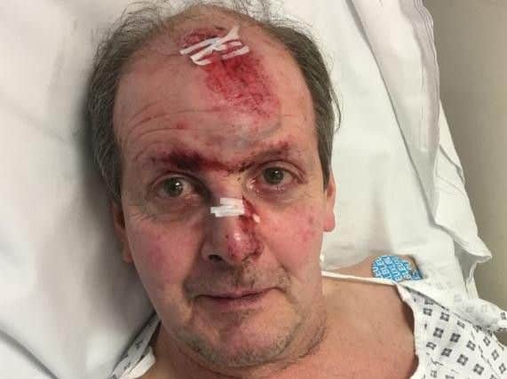 64-year-old Steven Ericsson is recovering from his injuries in hospital