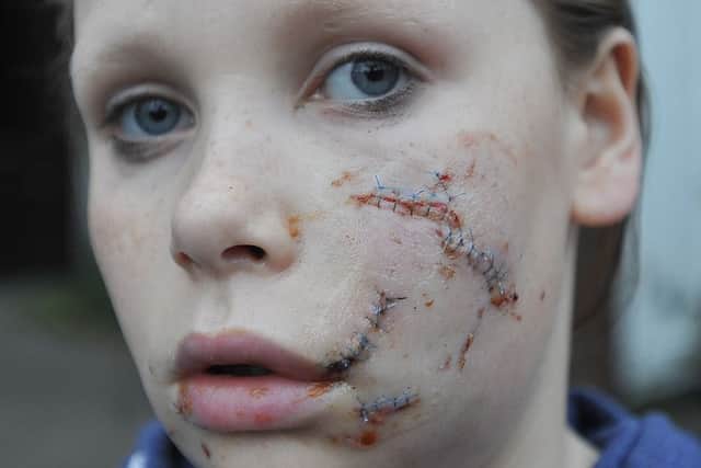 Georgia Sigourney (13) following the attack EMN-141028-202546009
