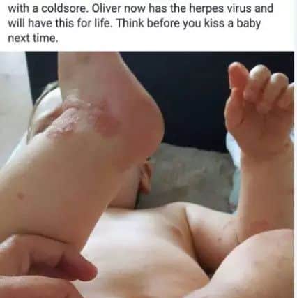 Amy Stinton took this picture of her 14-month-old son Oliver after he contracted the herpes simplex virus and came out in blisters