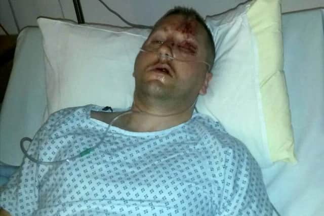 Matt Bullivant pictured recovering from his injuries after he fell through a balcony on his honeymoon. See SWNS story SWBALCONY; A new husband suffered a honeymoon from hell when he was seriously injured after he plummeted head first through a rotted balcony. Luckless newlywed Matt Bullivant, 36, had only just arrived at the bed and breakfast with his wife Marilyn, 51, when he went out to catch a glimpse of the picturesque surroundings. But the flimsy balustrade cracked under his weight and he fell 15ft - shattering his right hand and spitting open his head. The rest of his week-long honeymoon was spent in hospital.