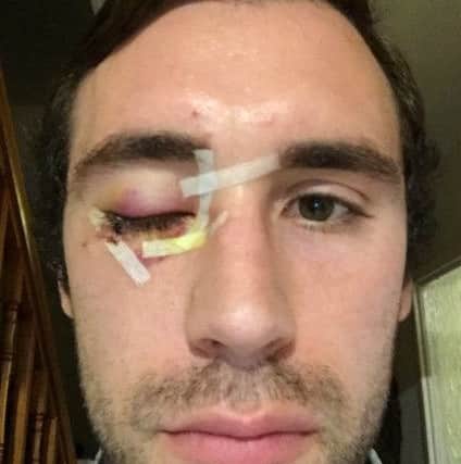 James Ferrara's eye injury.